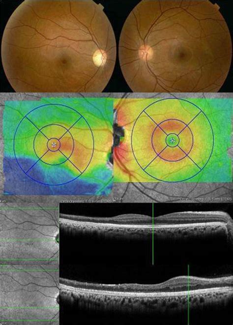 what is normal retinal thickness